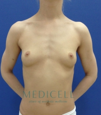 Трансаксилярное эндопротезирование груди